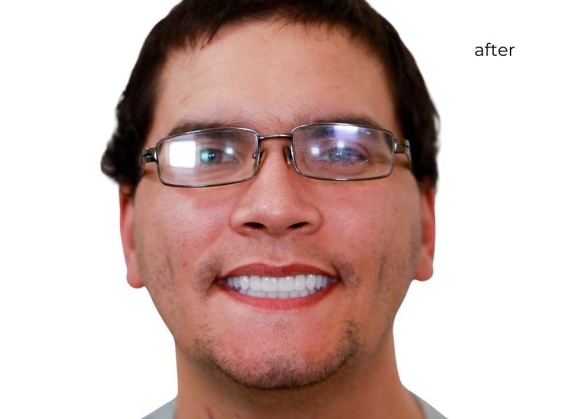 Man smiling after getting dental implants