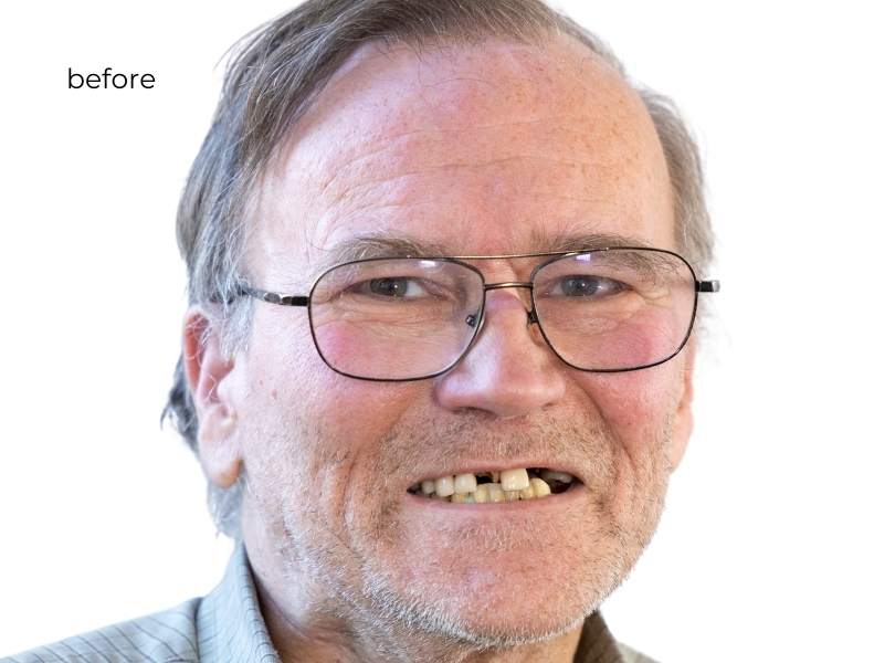 woman smiling before getting dental implants