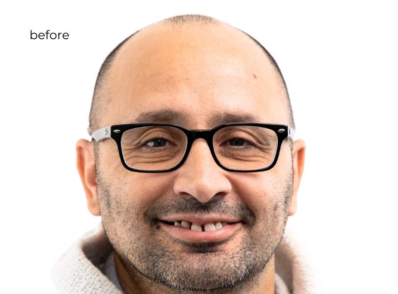 Man smiling before getting dental implants