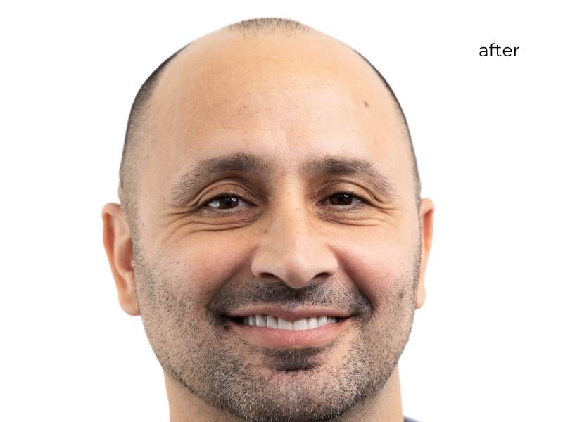Man smiling after getting dental implants