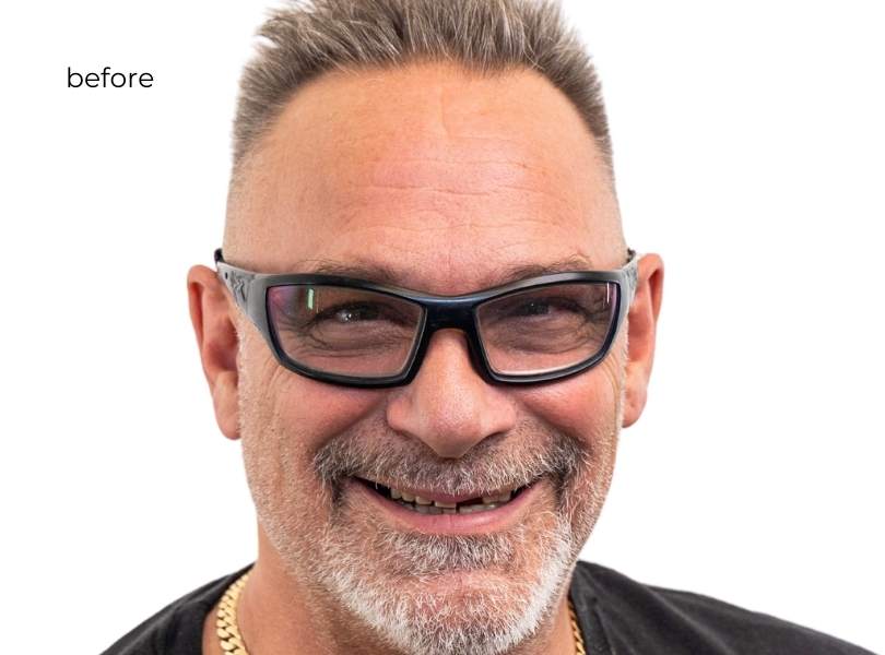 Man smiling before dental implants