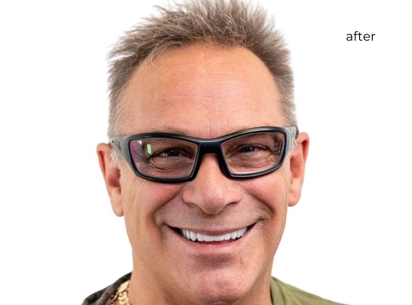 man smiling after getting dental implants
