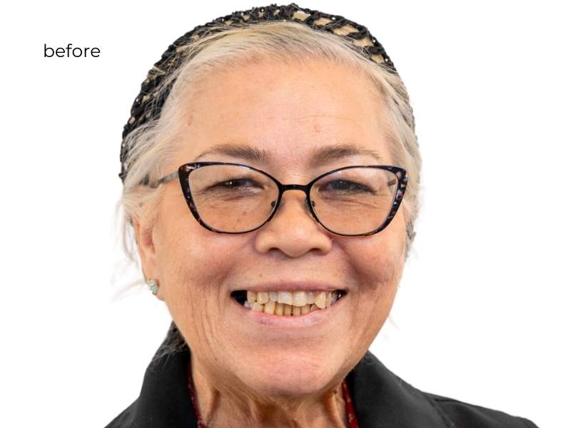 woman smiling before dental implants