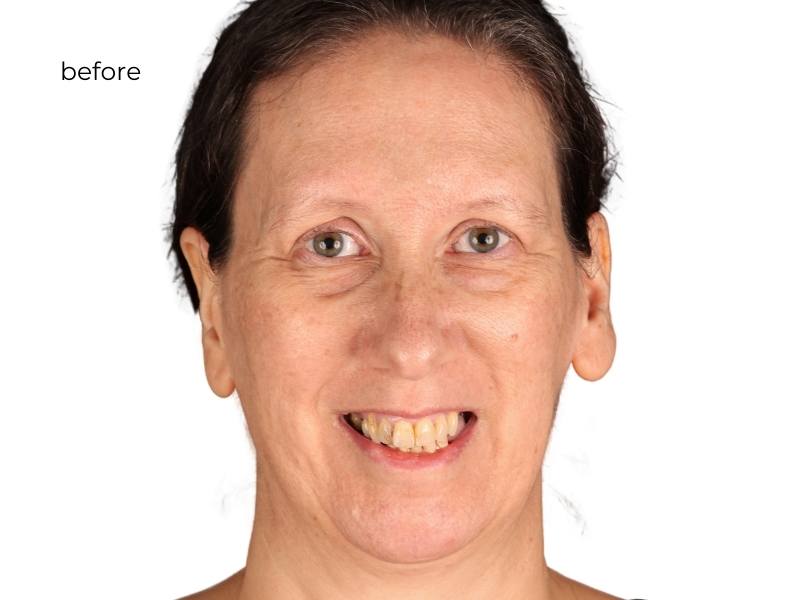 woman before getting dental implants