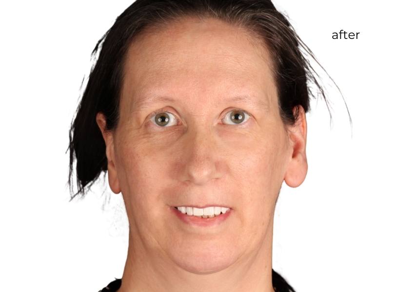 woman after getting dental implants