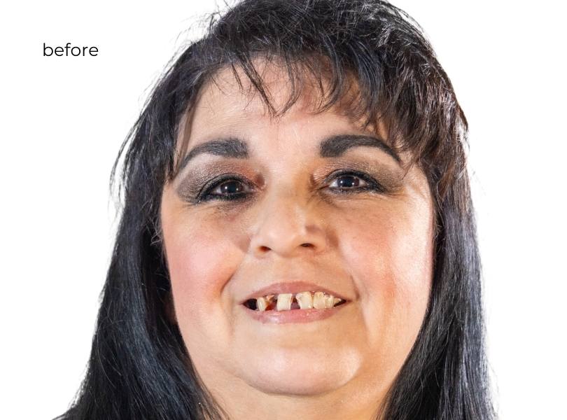 woman smiling before getting dental implants