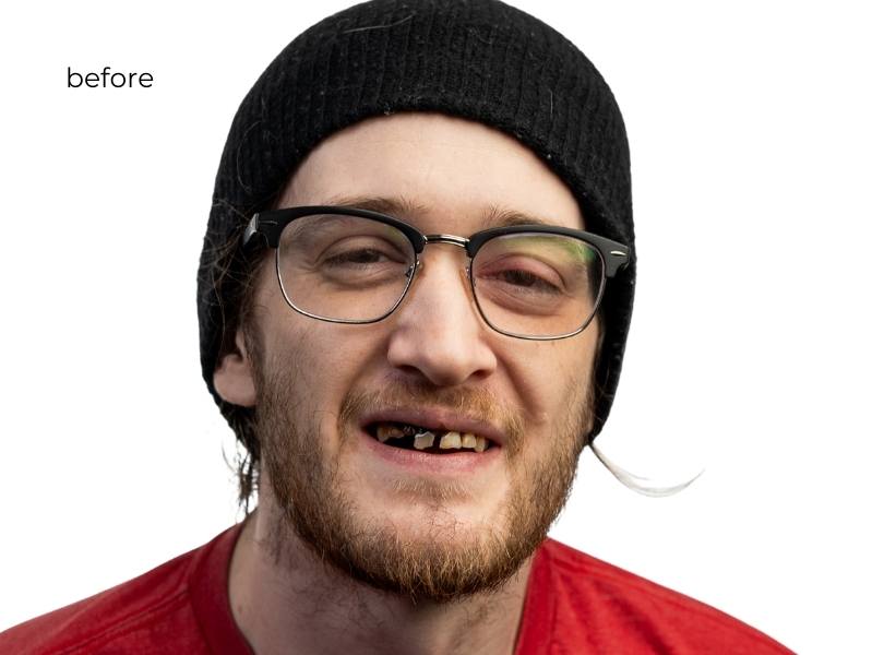 Man smiling before getting dental implants