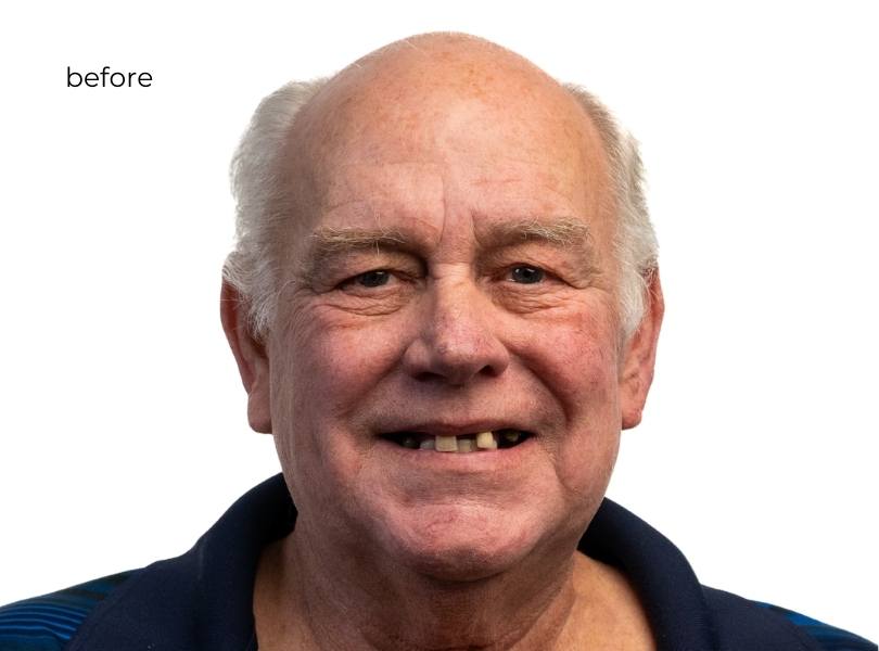 Man smiling before dental implants