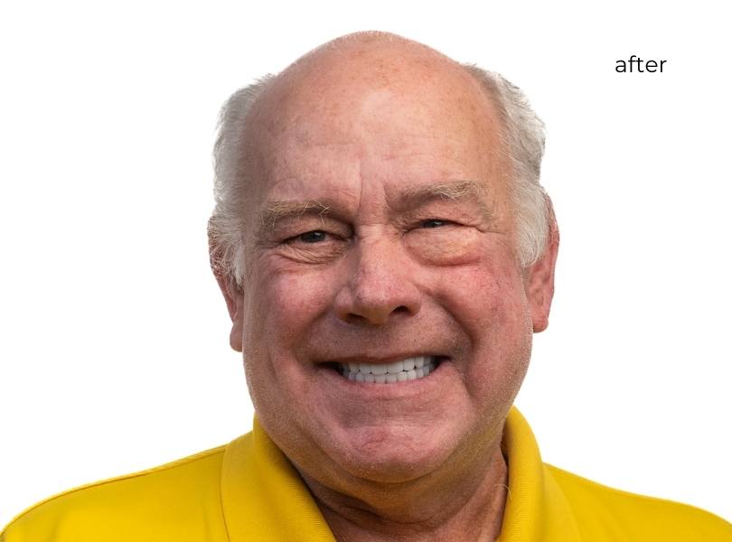 man smiling after getting dental implants
