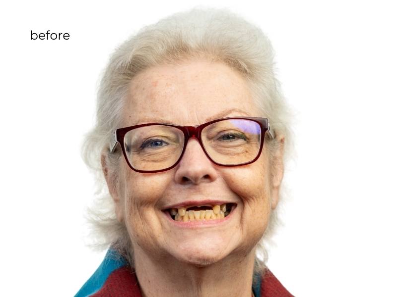 woman smiling before dental implants