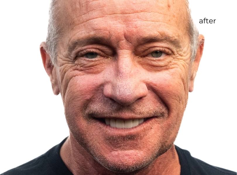 Man smiling after getting dental implants