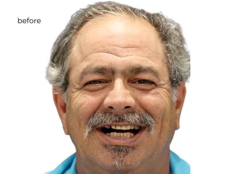 woman smiling before getting dental implants