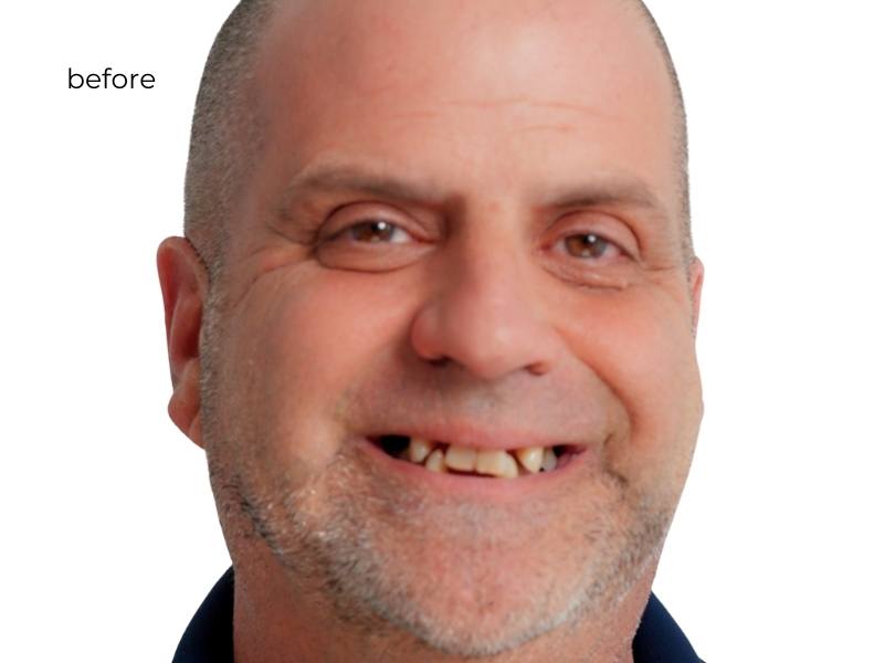 Man smiling before getting dental implants