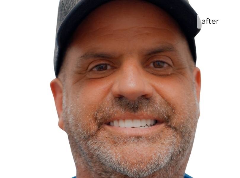 Man smiling after getting dental implants