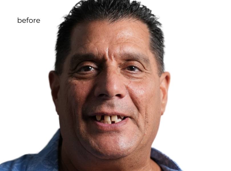 woman smiling before dental implants