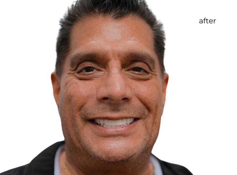Woman smiling after dental implants