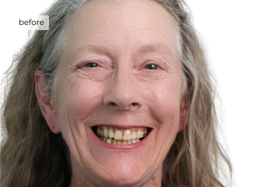 woman before getting dental implants