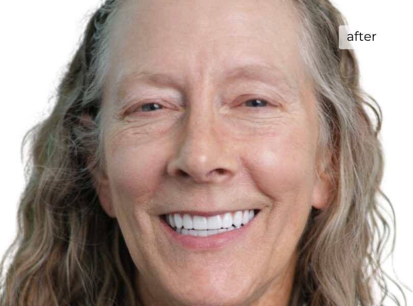 woman after getting dental implants