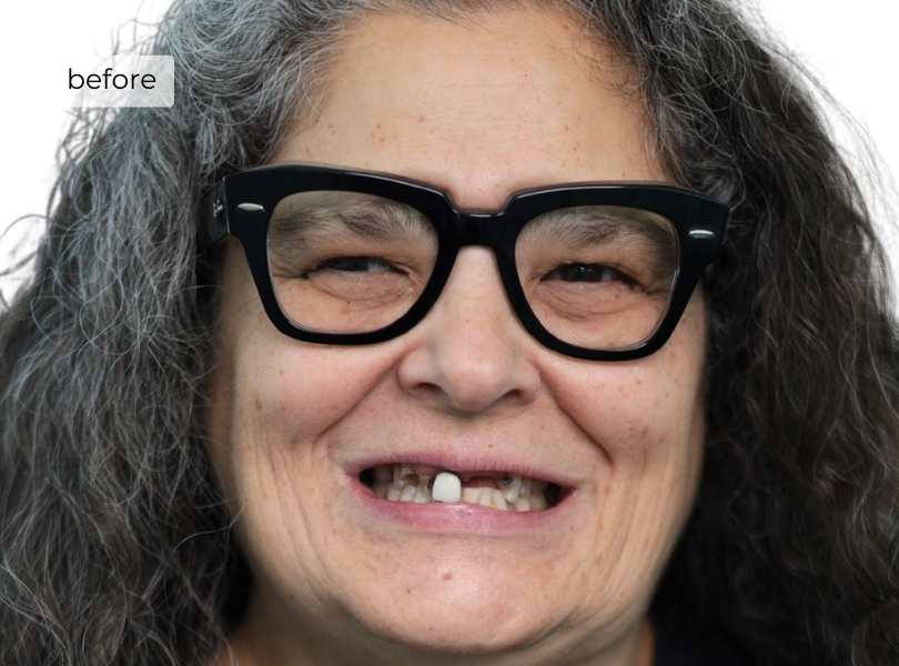 woman smiling before getting dental implants