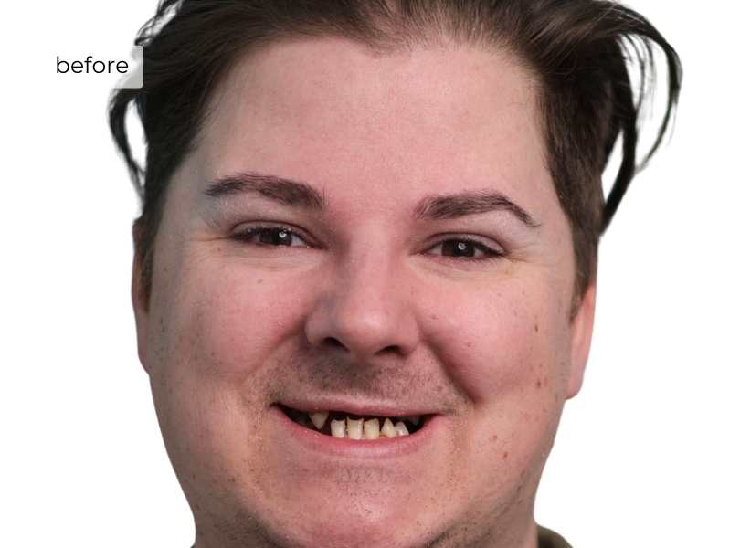Man smiling before getting dental implants