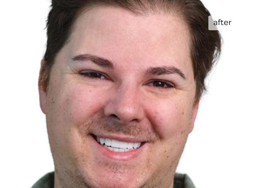 Man smiling after getting dental implants