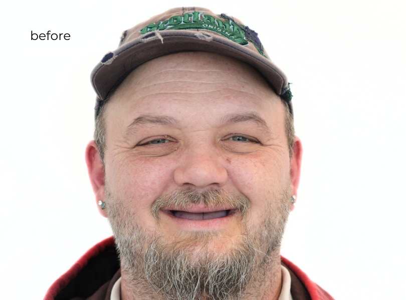 Man smiling before dental implants
