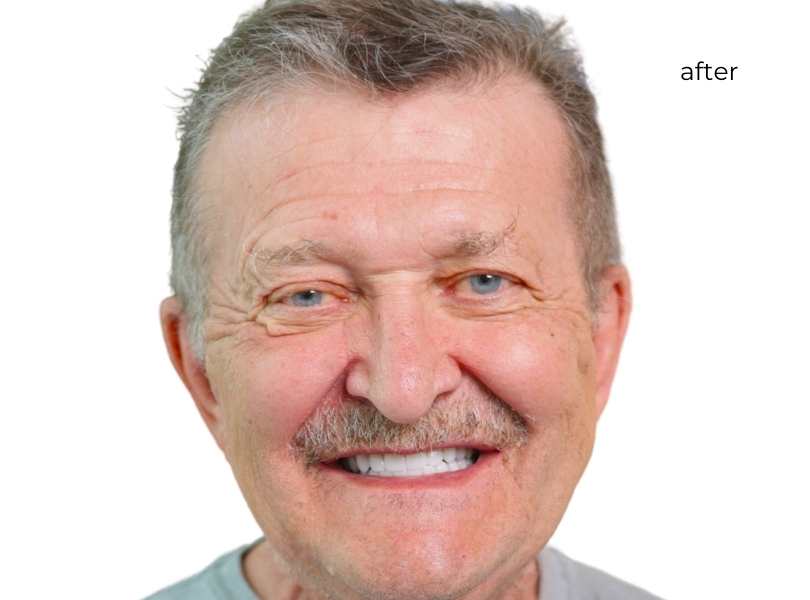Woman smiling after dental implants