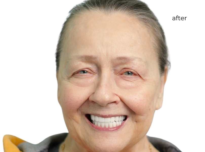 Man smiling after getting dental implants
