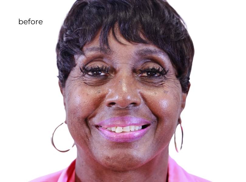 woman before getting dental implants