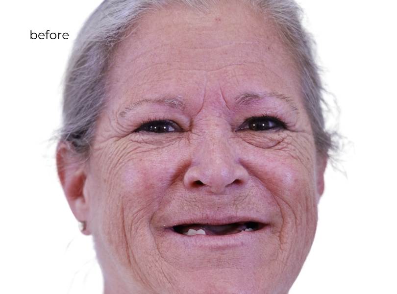 woman smiling before getting dental implants