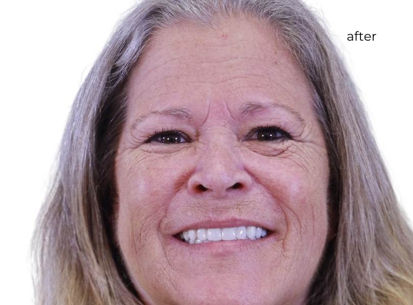 Woman smiling after getting dental implants