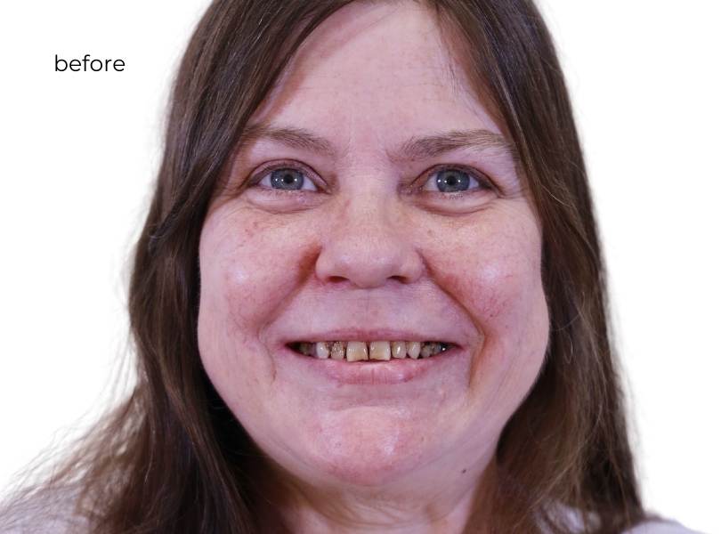 Man smiling before dental implants