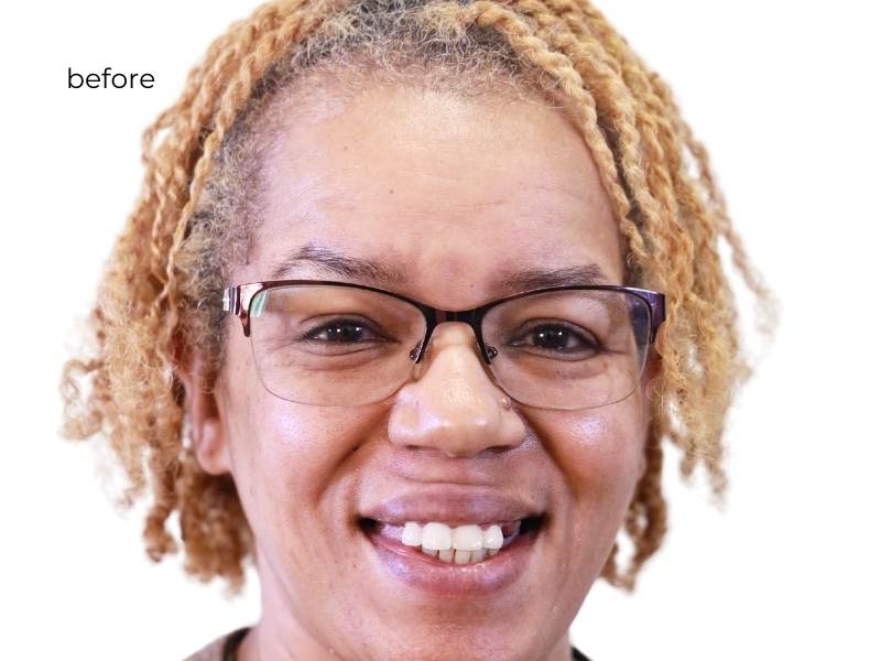 woman smiling before dental implants