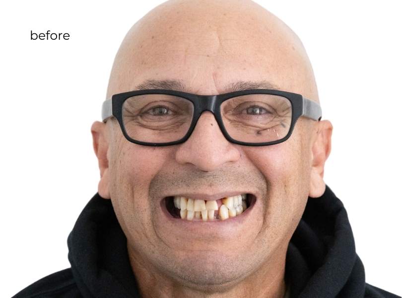 woman smiling before getting dental implants