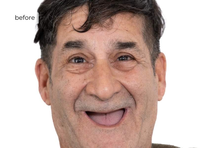 Man smiling before getting dental implants