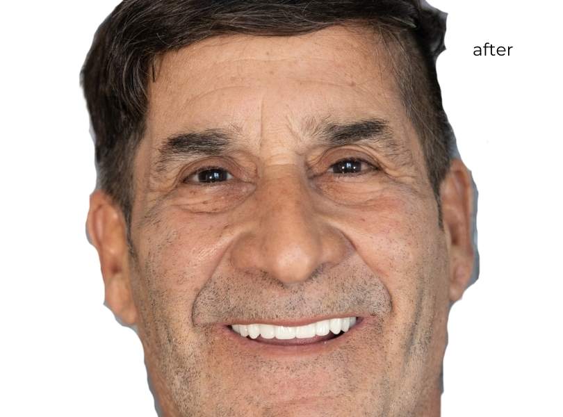 Man smiling after getting dental implants