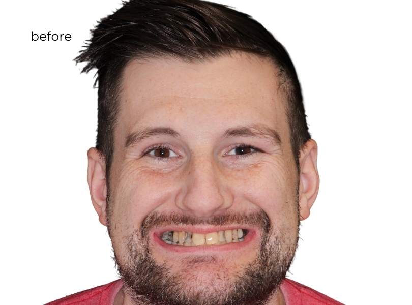 Man smiling before dental implants
