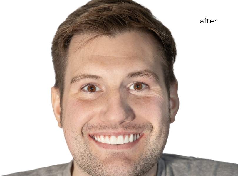 man smiling after getting dental implants