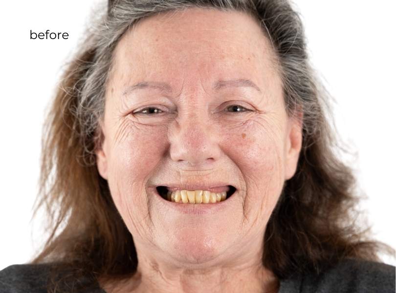 woman smiling before dental implants