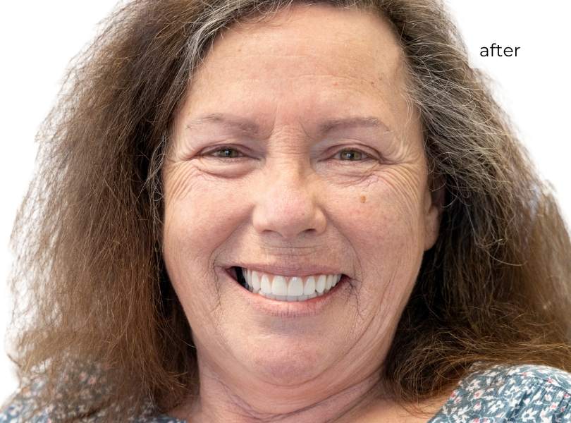 Woman smiling after dental implants
