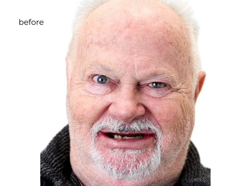 woman before getting dental implants