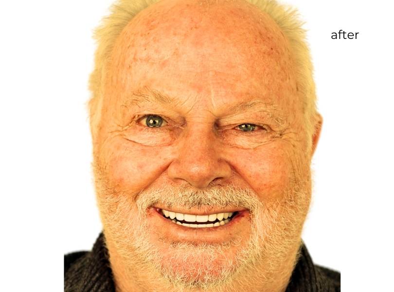 woman after getting dental implants