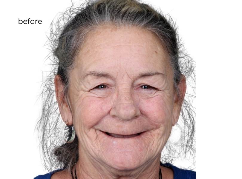 Man smiling before getting dental implants
