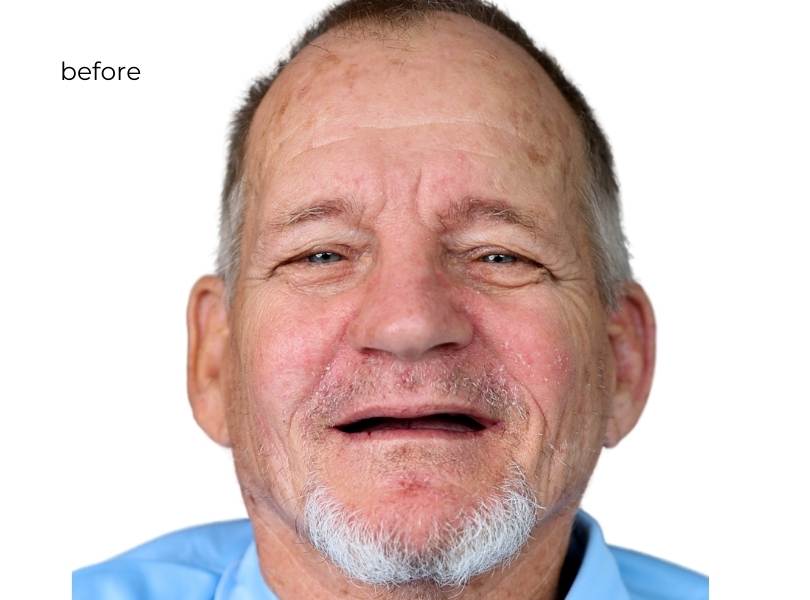 Man smiling before dental implants