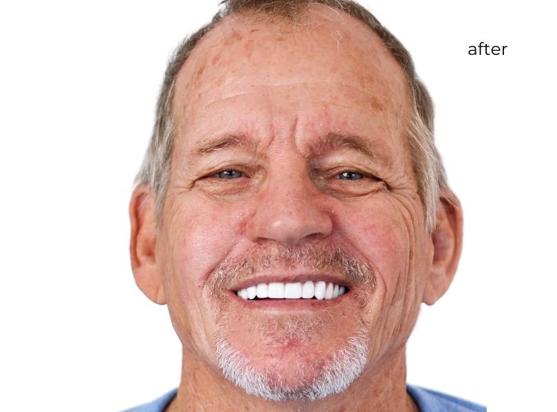 man smiling after getting dental implants