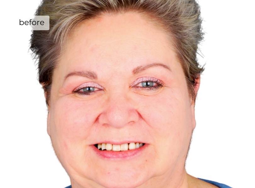 woman smiling before dental implants