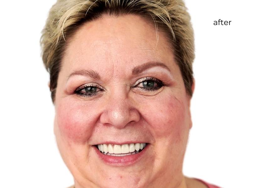 Woman smiling after dental implants
