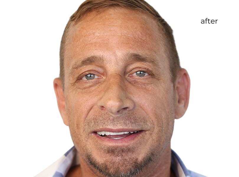 Man smiling after getting dental implants