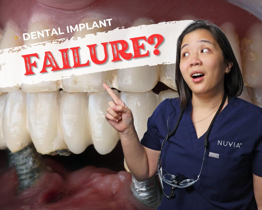 Dental Implant Failure Example and Graphic