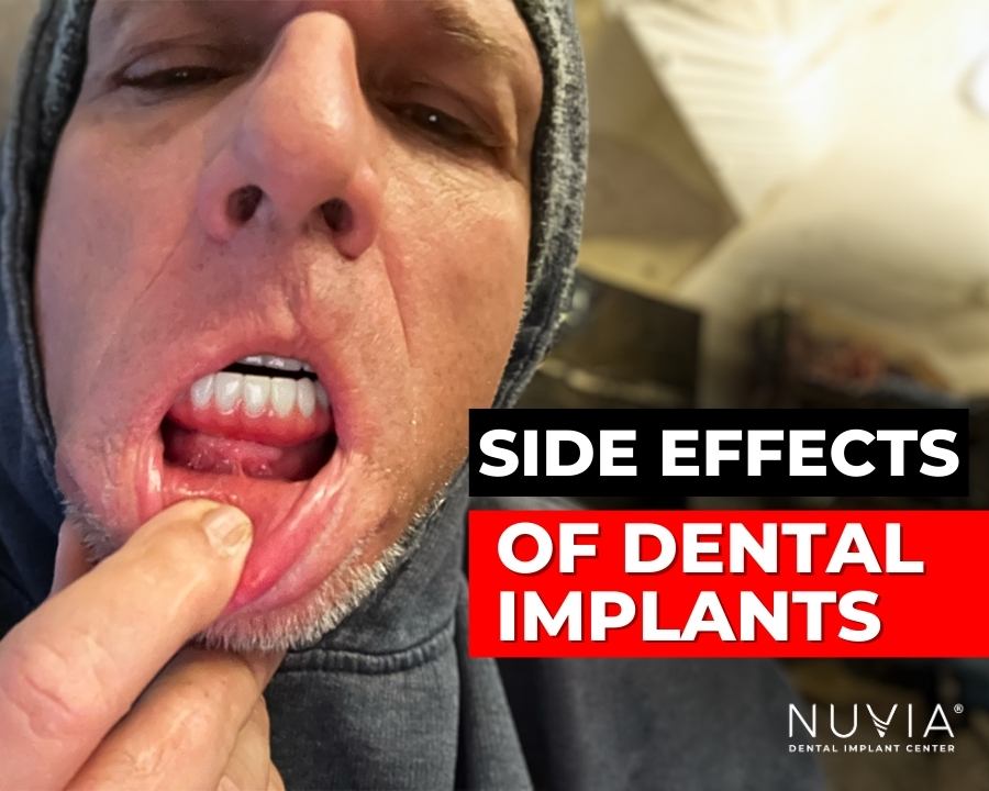 Dennis showing his dental implants with text that says side effects of dental implants